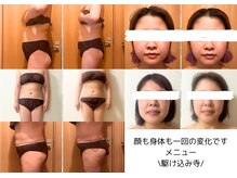 ルポ(RUPO)の雰囲気（痩身施術1回での変化です。医療ダイエットは3ヶ月3～15キロ減）