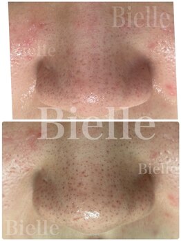 ビエル(Bielle)/黒いポツポツにさようなら