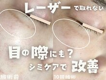 モモイロ(momoiro)の雰囲気（目の際もmomoiroのシミケアなら綺麗にさせていただきます☆）