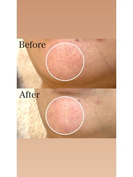 ブライダルエステ ジュエル(JEWEL)/毛穴エクストラクション