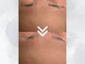 サイバーエステ 宇都宮店/ララピールで肌のゴワつきケア