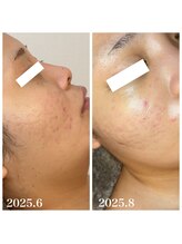 ココ(COCO)/ハーブピーリング/REVI/高知