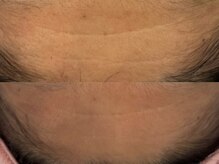 ベアール(beal)/ハーブピーリング4回目