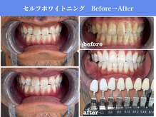 エクシアホワイトニング 岡崎店/白い歯で笑顔に★ホワイトニング