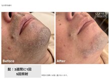 メンズスキンラボ(MEN'S SKIN LABO)の雰囲気（ヒゲ脱毛）