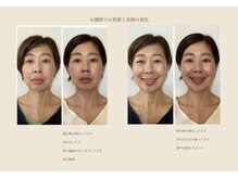 コムロイ(khomloi)の雰囲気（一度身に付けたら一生モノ表情筋トレーニングでたるみ&印象ケア）