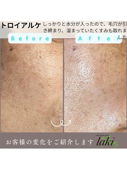 リラクゼーションサロン ラキ(laki)/トロイアルケ、施術後