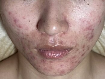 フィール(feel)/Before 期間:1年