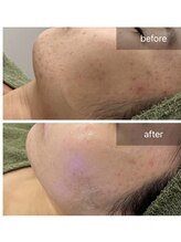 トータルビューティ リライフ(Total beauty Relife)/ハーブピーリング光フェイシャル