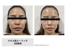 レア(Le'a)/【GLOSS肌ピーリング】