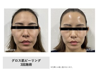 レア(Le'a)/【GLOSS肌ピーリング】