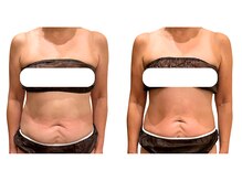 アイル(Isle)/痩身エステコース6回