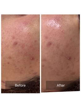 ビジュープラス 筑西下館店(Bijou+)/【20代お悩み】ニキビ/初回