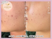 ハーバリー 天王寺(HERBERRY)/ハーブピーリング専門店HERBERRY