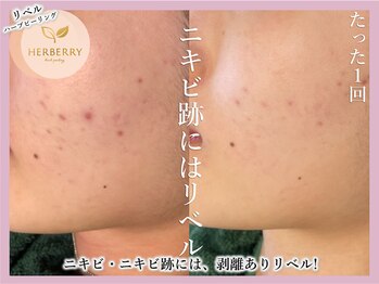 ハーバリー 天王寺(HERBERRY)/ハーブピーリング専門店HERBERRY