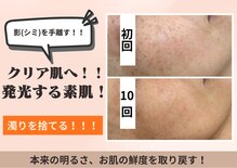 フォーエリミスプラス(for elims+)