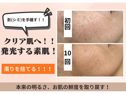 フォーエリミスプラス(for elims+)の写真