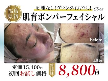 クリア(Clear)の写真/【繰り返す肌荒れに◎】お悩みに徹底アプローチ！ニキビ集中ケアで“できにくい肌”へ★剥離なし◎