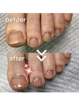 フットメンテ 巻き爪矯正センター 南浦和/ご紹介キャンペーン