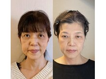 小顔22 ボルティ 赤坂支店(Bolty)/【悩み】50代：老け顔