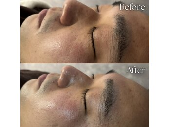 ヨハク 市川店(yohaku)/ハーブピーリング