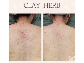 ダイヤモンド リーエンダ(Diamond leende)/クレイハーブピーリングBODY