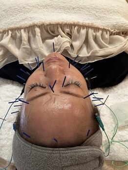 瑞 鍼灸院/美容鍼/リフトアップ/たるみケア