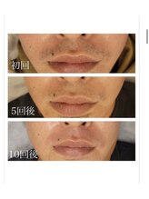 エアリアル 八代店/メンズヒゲ脱毛