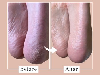 ベベ(Bebe)/女性/かかとガサガサお悩み