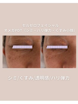 エン(enn.)/セルゼロフェイシャル/オメガPDT
