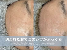 ラシック 加古川店(La chic.)/1回で叶う、額のエイジング