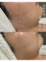 グレイス アンド ミューズ(grace&muse)/肌質改善お任せください