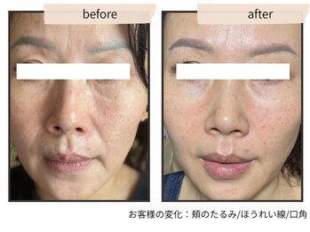 コンビンス(convince)の写真/【もう悩まない】土台から引き上げる最新肌育ケア★ホウレイ線・たるみにサヨナラして、若々しい印象へ！