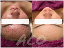 スキンケアスタジオ アコ 新宿店(Aco)の雰囲気（ハーブピーリングの本流、グリーンピールで輝く素肌へ13200円～）