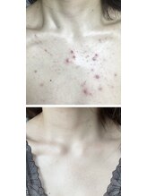 ビューティースパ/デコルテのニキビケアお任せ◎