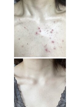 ビューティースパ/デコルテのニキビケアお任せ◎