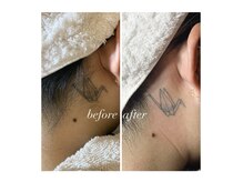 トゥルーカインド(true kind)/うなじWAX脱毛