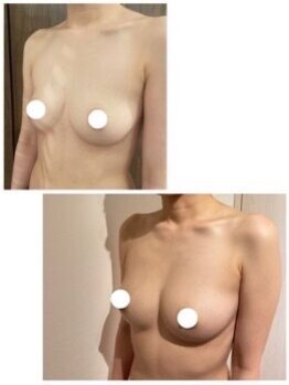 美人バスト 札幌店/バストアップ×育乳◇症例◇