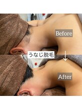 フォルチェ 春日(Folche)/うなじ脱毛で後ろ姿美人に♪