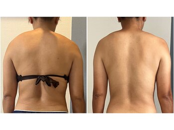 モア(moa)/ボディメイク/痩身