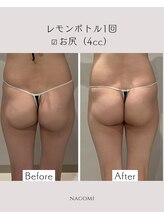 なごみ/脂肪分解【レモンボトル】