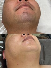 ホッコリ 府中店(HOKKORI)/ヒゲ脱毛～清潔感up！