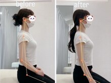 猫背改善【美容整体】Before /After◎スタイル改善に！
