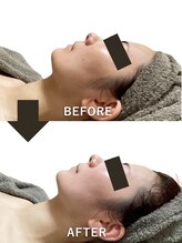 ベルペール(Belle perle) 小顔矯正 小顔リフト