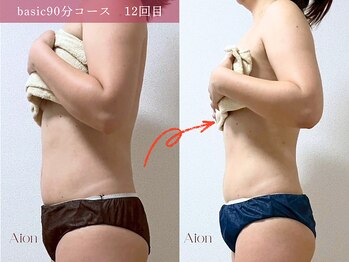 アイオン(Aion)/キャビテーション×ラジオ波