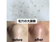 ビューティーネイル(Beauty Nail)/毛穴エクストラクション