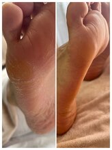 ドクターネイル爪革命 麻布十番店/【角質ケア】フットケア