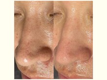 プティ 横浜店(Petit)/ハイドラフェイシャル