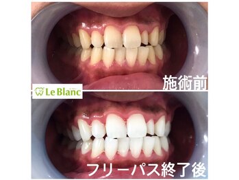 ルブラン 奈良店(Le Blanc)/魅力的な白い歯！！