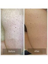 ルナート(Lunart)/ハーブピーリング【二の腕】